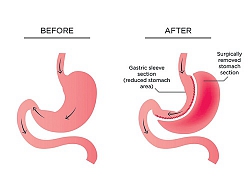 Những điều cần biết về phẫu thuật giảm cân