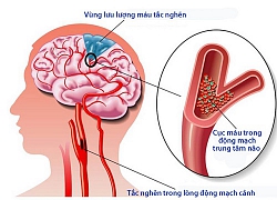 Xử trí tai biến mạch máu não nhớ tránh 3 điều sau