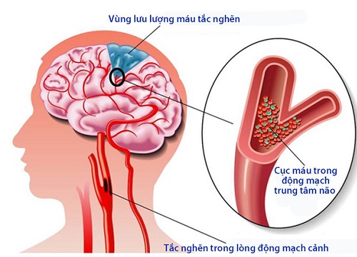 Xử trí tai biến mạch máu não nhớ tránh 3 điều sau