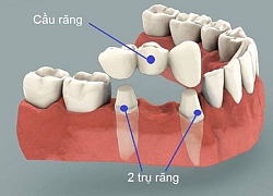 Những điều chưa biết về làm Cầu Răng Sứ