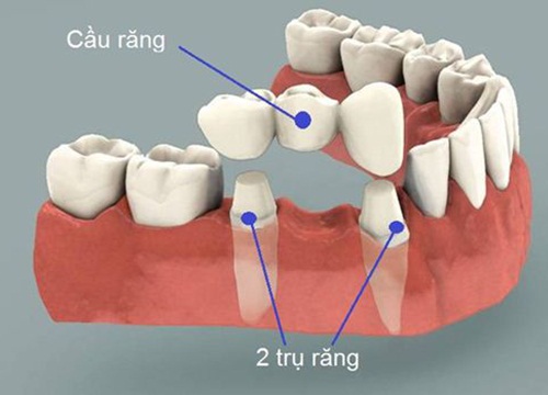 Những điều chưa biết về làm Cầu Răng Sứ