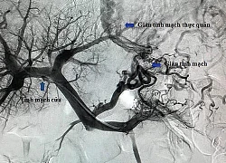 Nôn ra máu do nghiện rượu