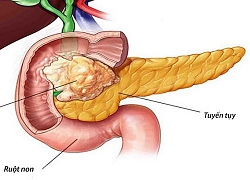 Ung thư tụy vì sao khó chữa nhất?