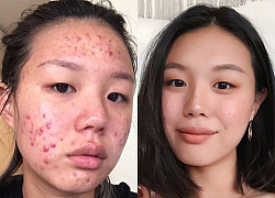 Beauty blogger Hàn Quốc tiết lộ 4 'bảo bối' giúp trị sạch mụn bọc