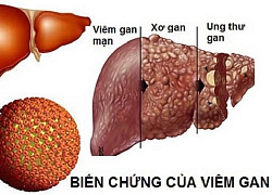 Giám đốc 40 tuổi bị ung thư gan vì làm 4 việc trong thời gian dài