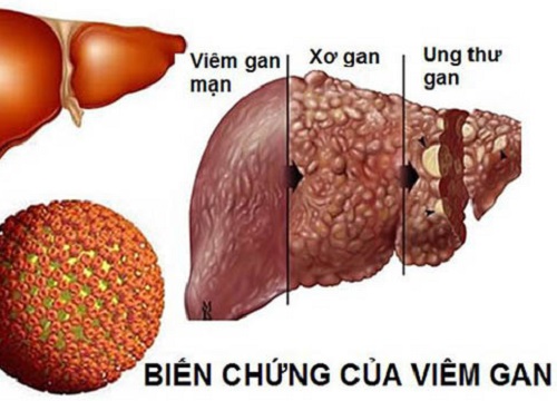 Giám đốc 40 tuổi bị ung thư gan vì làm 4 việc trong thời gian dài