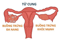 5 bệnh lý ở buồng trứng gây hiếm muộn