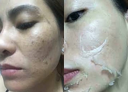 Không chỉ kem trộn, xu hướng tự peel da tại nhà cũng có thể khiến bạn "hóa quỷ" sau 1 lần sử dụng