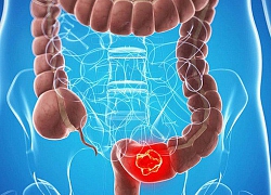 Người đàn ông tử vong do ung thư đại trực tràng nhưng dấu hiệu cảnh báo trước đó mới là điều mọi người cần cảnh giác