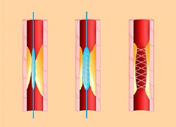 Stent tim: Đặt hay không đặt?