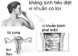 Thủ phạm gây viêm 'vùng kín' và cách trị