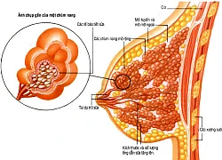 Phẫu thuật thẩm mỹ u vú không để lại sẹo