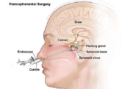 Nội soi đường mũi phẫu thuật lấy u tuyến yên khổng lồ
