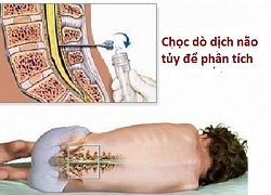 Bác sĩ chỉ cách nhận biết sớm trẻ bị viêm não, cha mẹ nào cũng cần biết