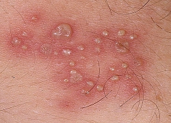 Quan hệ tình dục sớm, thiếu nữ bị nhiễm herpes sinh dục