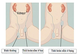 Tinh hoàn nằm trong ổ bụng, bé trai 5 tuổi được nội soi hạ về "đúng vị trí"