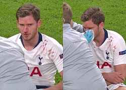 Dính đòn của đồng đội, Jan Vertonghen đổ máu mũi