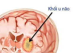 Những dấu hiệu cảnh báo khối u não bạn nên biết