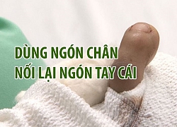 Ca phẫu thuật kỳ lạ: Biến ngón chân thành ngón tay cái cho người đàn ông