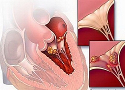 Cô gái 26 tuổi bị viêm cơ tim cấp được cứu sống kịp thời