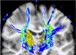 Cảnh giác với bệnh Parkinson nếu mắt có những triệu chứng này