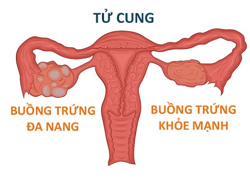 uồng trứng đa nang có gây hiếm muộn?