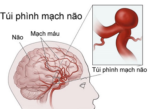 7 cách phát hiện chứng phình động mạch não trước khi quá muộn (P1)