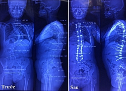 Cảnh báo nhiều học sinh vẹo cột sống sớm