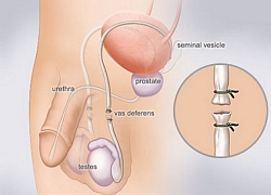 Thắt ống dẫn tinh xong, tự nhiên... có con lại?