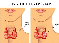 5 câu hỏi thường gặp nhất về bệnh ung thư tuyến giáp