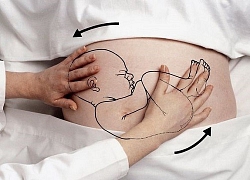 Sinh thường ngôi mông - Thách thức nguy hiểm cho cả mẹ bầu và bác sĩ sản khoa và đây là hình ảnh thực tế nhất