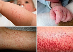 Cách phân biệt sốt xuất huyết với sốt virus thông thường