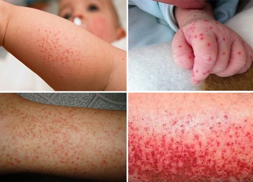Cách phân biệt sốt xuất huyết với sốt virus thông thường - Sức khỏe - Việt  Giải Trí