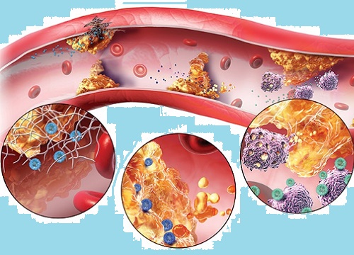 Kiểm soát các yếu tố gây rối loạn mỡ máu