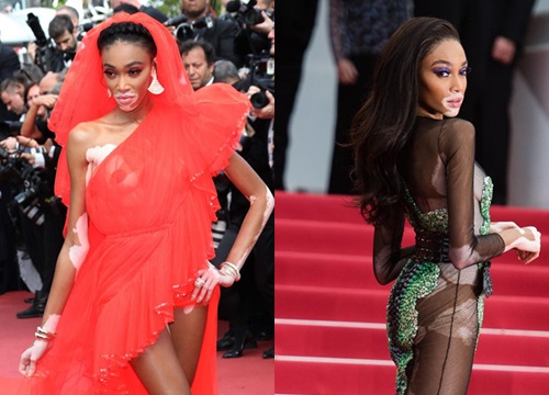 Mẫu bạch biến Winnie Harlow chuộng trang phục màu mè