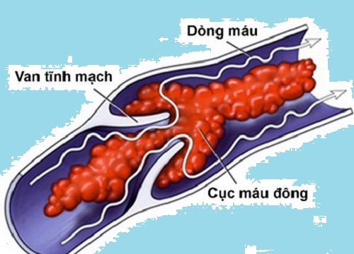 Người dùng thuốc trị loãng xương sẽ gặp những khó chịu này