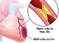 Nhồi máu cơ tim ở trẻ em