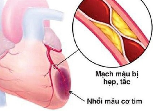 Nhồi máu cơ tim ở trẻ em