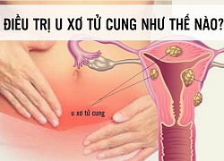 Điều trị u xơ tử cung như thế nào?