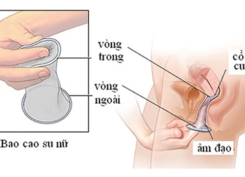 Bạn gái hãy tự bảo vệ mình với bao cao su cho nữ giới