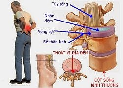 Các triệu chứng báo hiệu bệnh thoát vị đĩa đệm