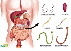 Đau bụng suốt 10 năm, bác sĩ gắp ra con vật gớm ghiếc trong bụng