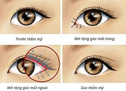 Mở rộng góc mắt có sẹo không?