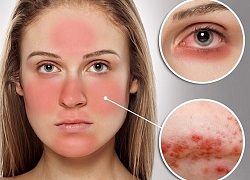 Biểu hiện của bệnh lupus ban đỏ - bệnh miễn dịch có thể gây biến chứng nguy hiểm đến toàn bộ cơ thể