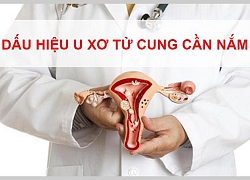 Dấu hiệu u xơ tử cung mà các chị em nhất định phải nắm rõ