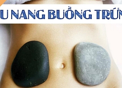 U nang buồng trứng là bệnh gì mà đến 80% phụ nữ đều có thể mắc phải