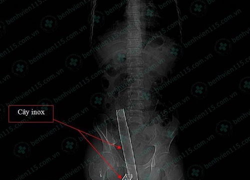 Vô bệnh viện cùng cây inox dài hơn 1m xuyên qua mông