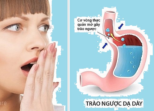 Dấu hiệu trào ngược dạ dày bạn nên biết