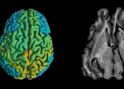 Kỹ thuật MRI mới giúp sớm phát hiện các căn bệnh thoái hóa thần kinh