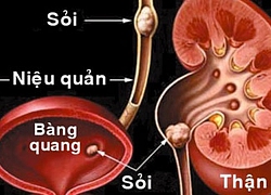 Những điều cần biết về phương pháp tán sỏi qua da điều trị sỏi thận